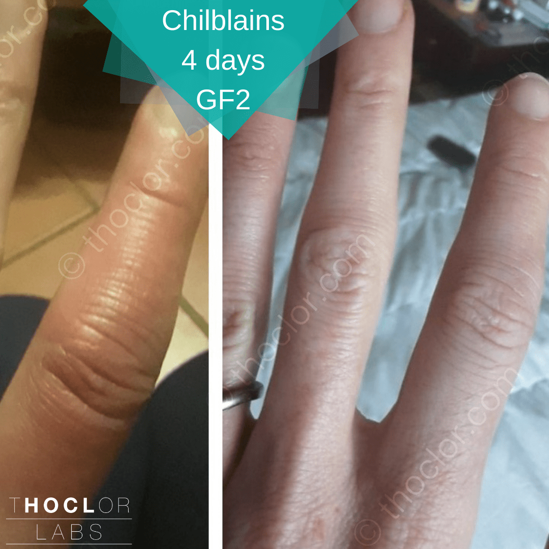 chilblains soothed with GF2
